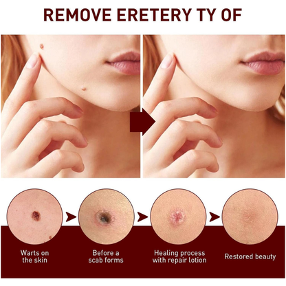 Liquid Wart and Skin Tag Removal